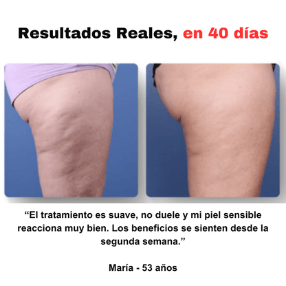 ¡Última oportunidad! Esta oferta expira en 2 horas - SmoothGlow™ - Masajeador anticelulítico